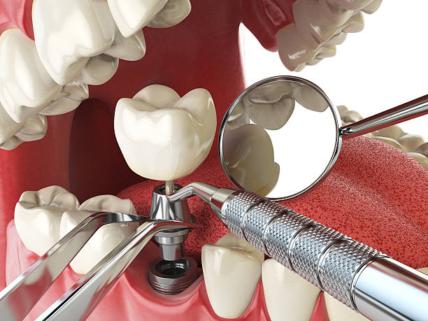 Best Emergency Dental Care for Broken or Chipped Teeth in Porterville, CA